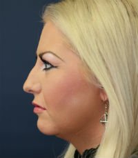 Rhinoplasty San Diego Case 29 - before - front