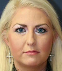Rhinoplasty San Diego Case 29 - before - side