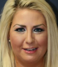 Rhinoplasty San Diego Case 29 - after - side