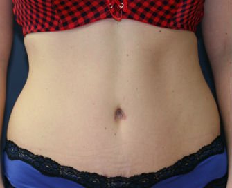 Tummy Tuck San Diego Case 36 - after - front