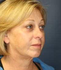Facelift San Diego Case 18 - before - oblique