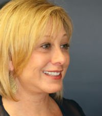 Facelift San Diego Case 18 - after - oblique