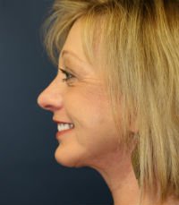 Facelift San Diego Case 18 - after - side