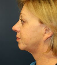 Chin Case 5 - before - front