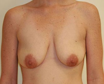 Breast Lift Case 3 - before - front