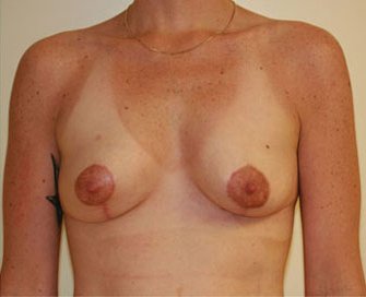 Breast Lift Case 3 - after - front