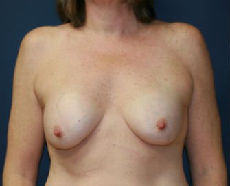 Breast Revision San Diego 11 - before - front