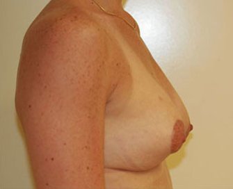 Breast Lift Case 3 - after - side