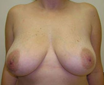 Breast Lift Case 4 - before - front