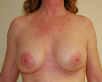 Breast Revision San Diego 17 - after - front
