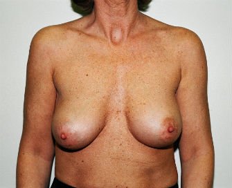 Breast Revision San Diego 18 - after - front