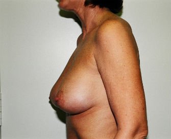 Breast Revision San Diego 18 - after - side