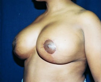 Breast Reduction San Diego 4 - after - oblique