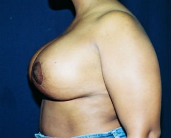 Breast Reduction San Diego 4 - after - side
