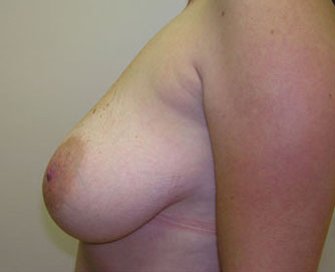 Breast Lift Case 4 - before - side