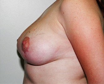 Breast Lift Case 4 - after - side