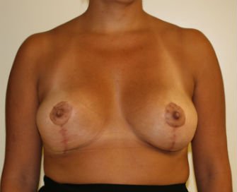 Breast Reduction San Diego 9 - after - front
