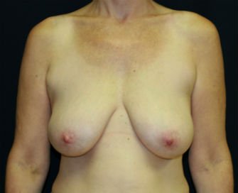 Breast Reduction San Diego 12 - before - front