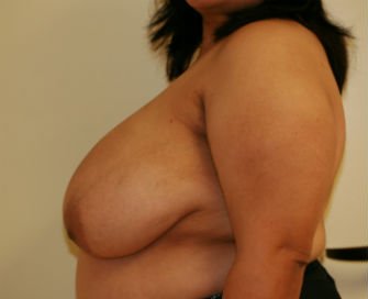 Breast Reduction San Diego 14 - before - side