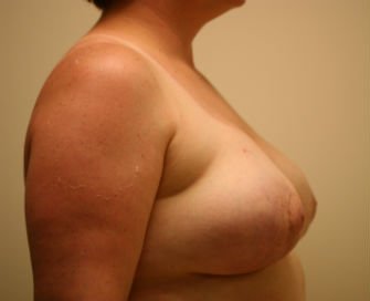 Breast Reduction San Diego 16 - after - side