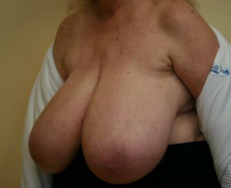 Breast Reduction San Diego 17 - before - oblique