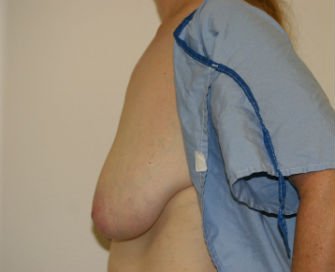Breast Lift San Diego Case 17 - before - oblique