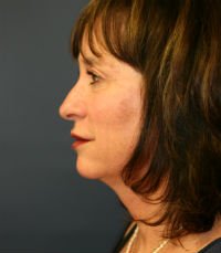 Facelift San Diego Case 20 - before - side