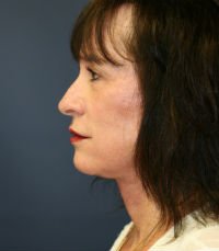 Facelift San Diego Case 20 - after - side