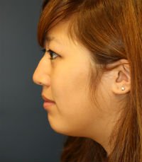 Rhinoplasty San Diego Case 32 - before - front