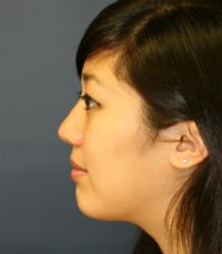 Rhinoplasty San Diego Case 32 - after - front