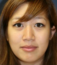 Rhinoplasty San Diego Case 32 - before - side