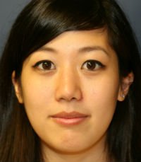 Rhinoplasty San Diego Case 32 - after - side