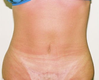 Mini tummy tuck San Diego, Case 3 - after - front