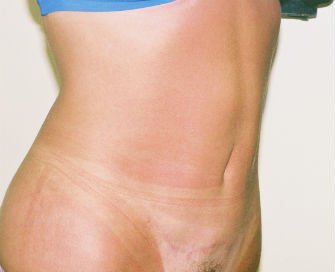 Mini tummy tuck San Diego, Case 3 - after - oblique