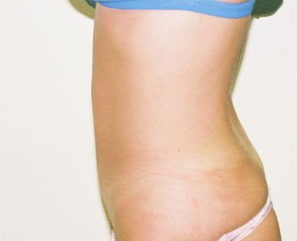 Mini tummy tuck San Diego, Case 3 - after - side