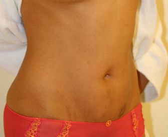 Mini Tummy Tuck San Diego, Case 7 - after - front