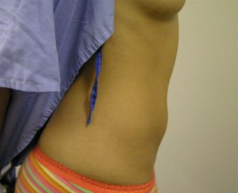 Mini Tummy Tuck San Diego, Case 7 - before - side