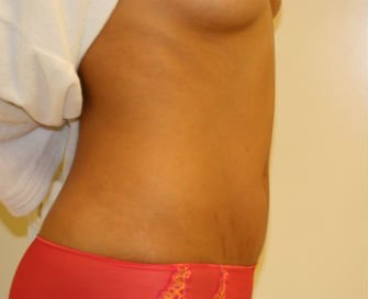Mini Tummy Tuck San Diego, Case 7 - after - side
