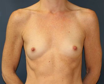 Breast Augmentation Case 58 - before - front