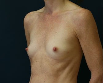 Breast Augmentation Case 58 - before - oblique
