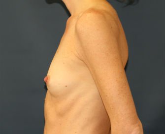 Breast Augmentation Case 58 - before - side