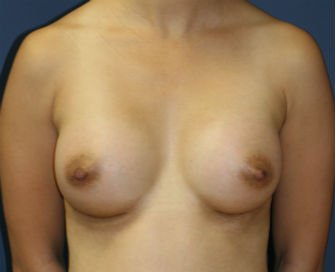 Breast Augment San Diego, Case 60 - after - front