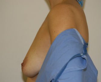 Breast Augment-Lift San Diego Case 12 - before - side