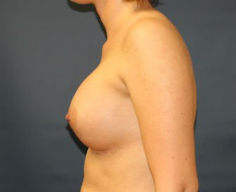 Breast Augmentation Case 62 - after - side