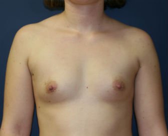 Breast Implants San Diego 62a - before - front