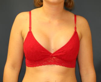 Breast Implants San Diego 62a - after - front