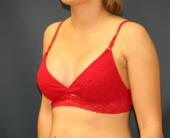 Breast Implants San Diego 62a - after - oblique