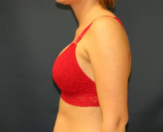 Breast Implants San Diego 62a - after - side