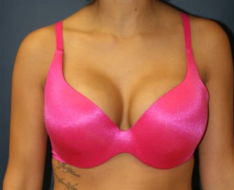 Breast Augmentation San Diego Case 47a - after - front
