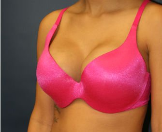 Breast Augmentation San Diego Case 47a - after - oblique